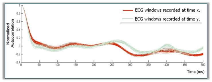 ECG